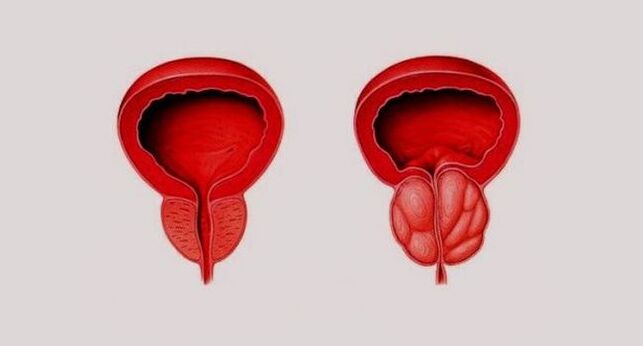 Próstata saudável (esquerda) e inflamada devido à prostatite (direita)