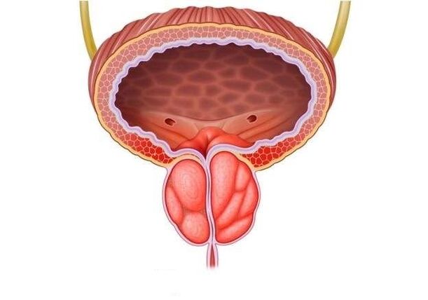 inflamação da próstata em homens