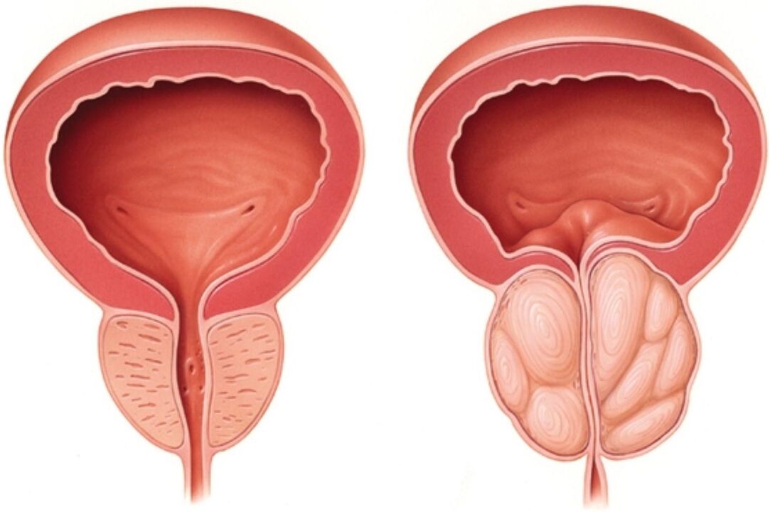 Próstata normal (esquerda) e com sinais de inflamação na prostatite (direita)