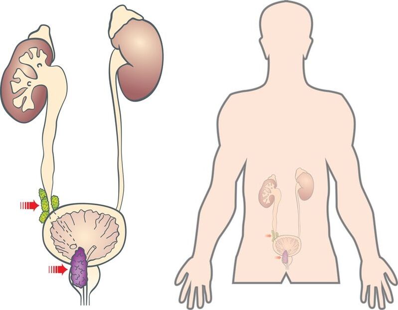 sintomas e causas do adenoma da próstata