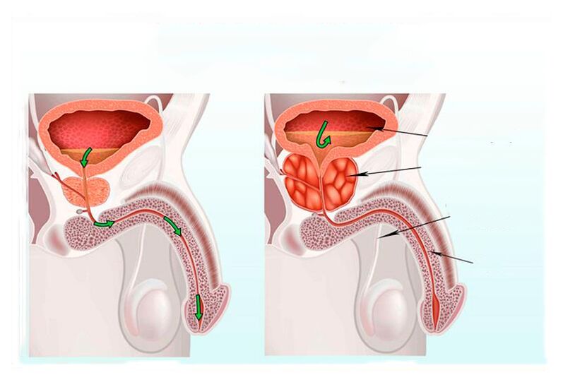 norma e inflamação da próstata